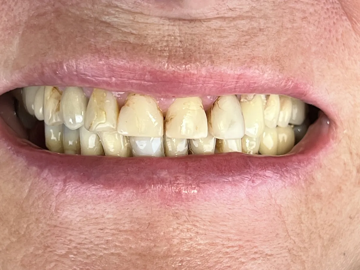 Antes: dientes manchados y desgastados