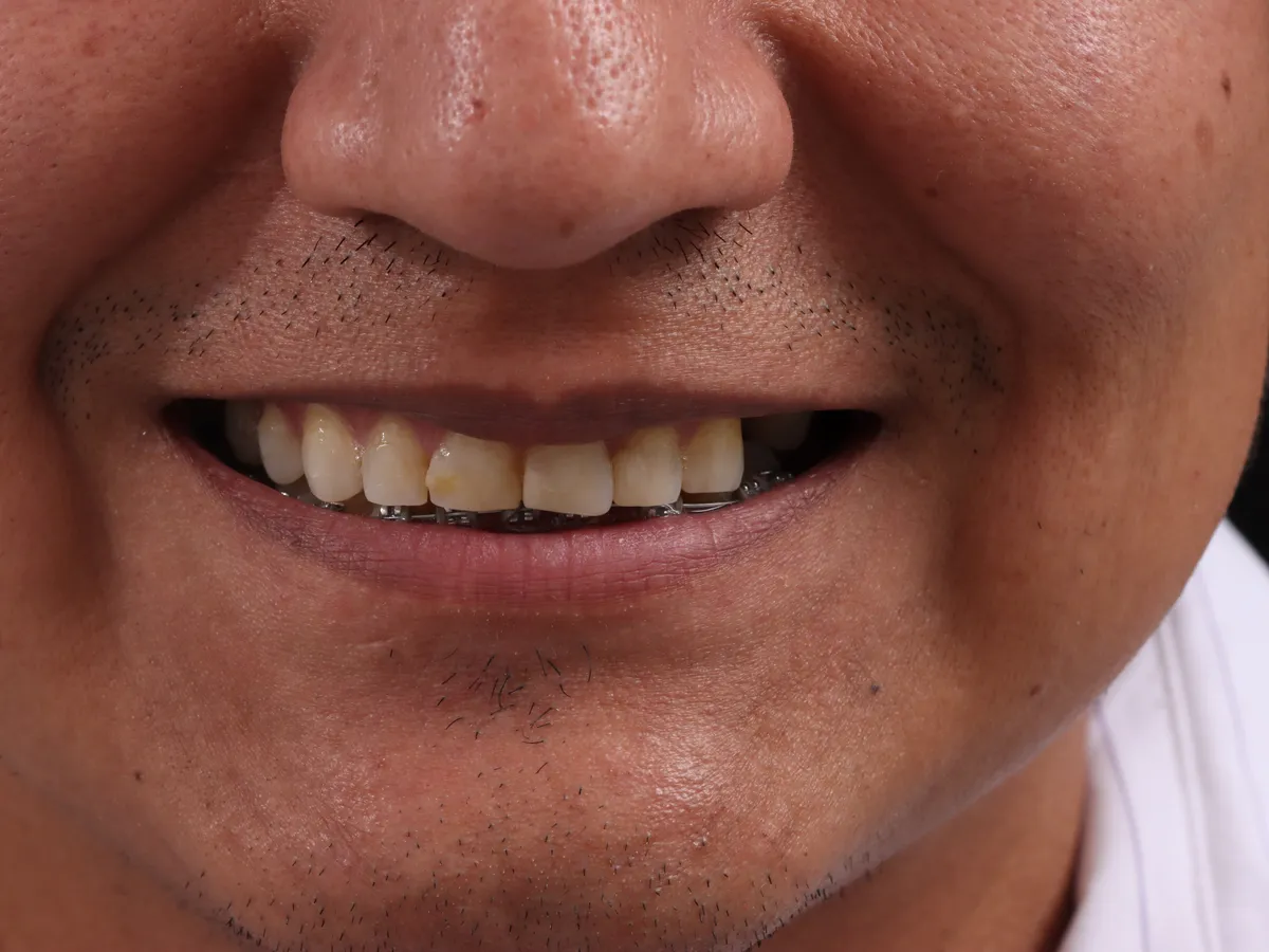 Antes: dientes de distinto color y forma