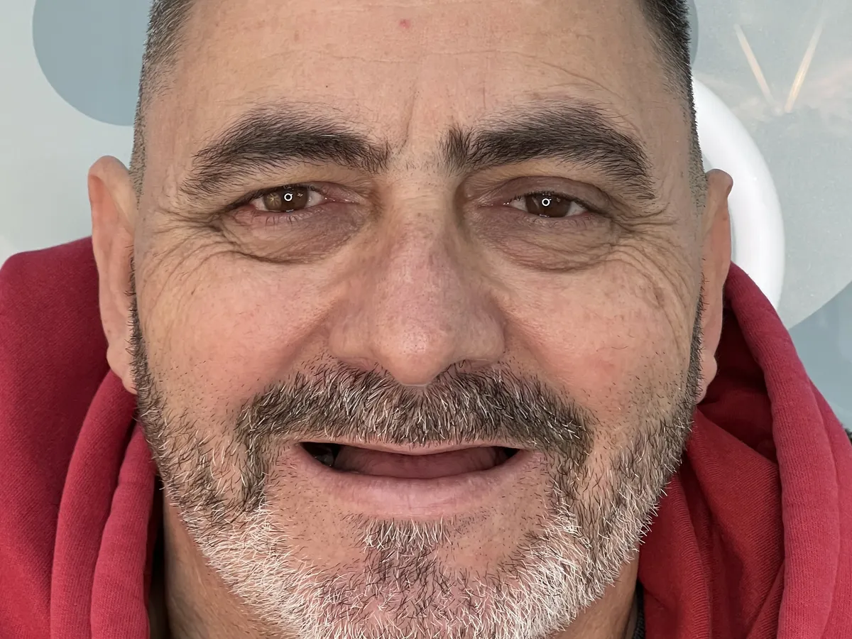 Antes: maxilar superior sin dientes